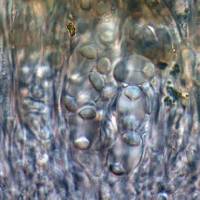 Lacrima epiphora image